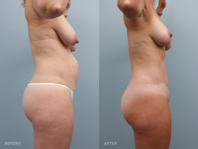 Patient showing before and after results of undergoing a tummy tuck surgery