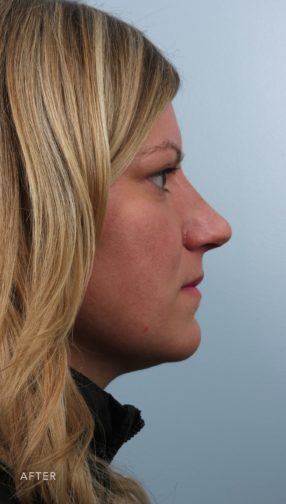 This is the side profile of woman with blonde hair after undergoing a rhinoplasty.