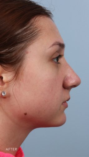 This is the side profile view of a brunette girl after undergoing an endonasal rhinoplasty procedure. Her nose is now much smoother.