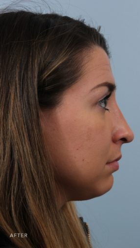 This is the side profile of a brunette woman after undergoing a rhinoplasty procedure.