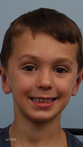 This is the front view of a young boy in a blue shirt after his otoplasty procedure.