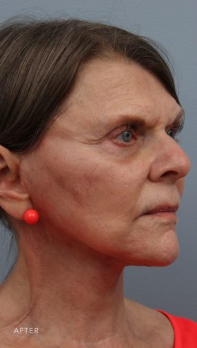 This is the oblique view of a brunette woman after undergoing a lower face and neck lift surgery. She is wearing a pink shirt and earrings.