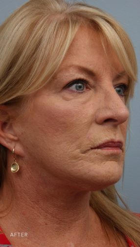 This is the oblique view of a blonde woman after undergoing a lower face and neck lift and a chemical peel. She is wearing a pink shirt and gold earrings.