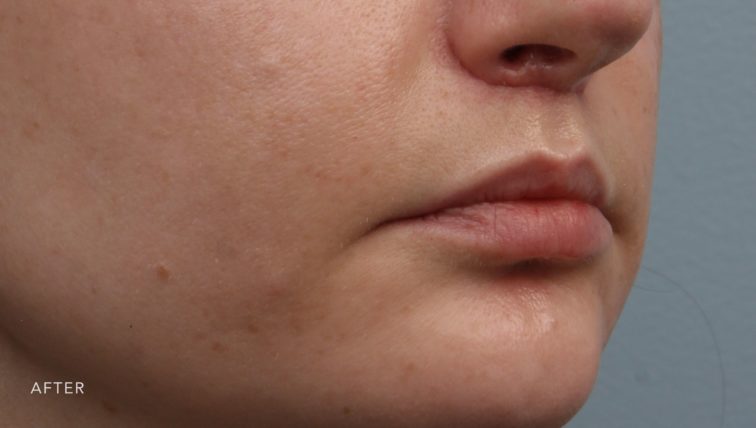 This is the oblique view of a woman's lips after she got a lip lift. Her upper lift appears much fuller.