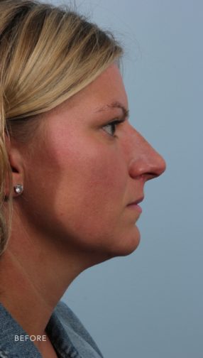 This is the side profile of woman with blonde hair before undergoing a rhinoplasty.