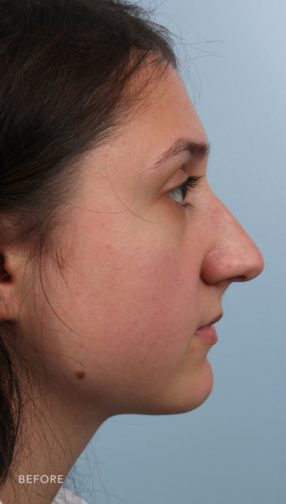 This is the side profile view of a brunette girl before undergoing an endonasal rhinoplasty procedure. Her nose has a slight bump and droops slightly.