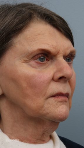 This is the oblique view of a woman before undergoing a lower face and neck lift procedure. She has sagging skin on the lower parts of her face. She is wearing a white and black shirt.
