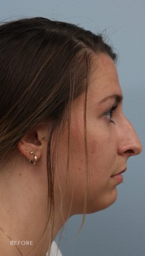 This is the side profile of a brunette woman before undergoing a rhinoplasty procedure to fix her slightly crooked and drooping nose.