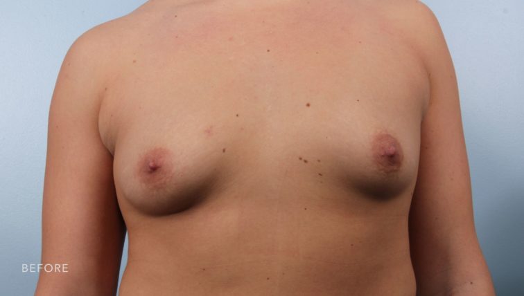 This is the front view of a woman before undergoing a breast augmentation.