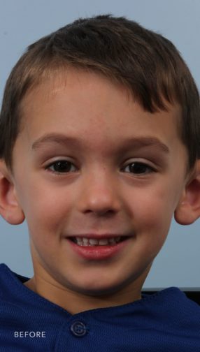 This is the front view of a young boy in a blue shirt before his otoplasty procedure. His ears stick out off of his head.