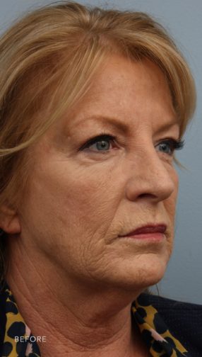 This is the oblique view of a blonde woman before undergoing a lower face and neck lift. She has sagging skin on her face as well as her neck. She is wearing a black shirt with a cheetah print collar.