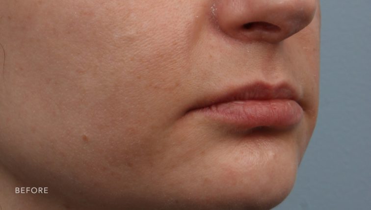 This is the oblique view of a woman's lips before she got a lip lift. Her upper lift appears quite small and thin.