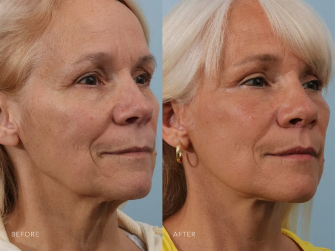 A side by side view of a patient who had a Deep Plane Face Lift. Before she had sagging skin with volume loss in her mid face. After her facelift the volume in her face is restored.