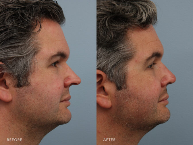 Side by side before and after of a man who had rhinoplasty surgery in Albany, NY. His tip was made smaller and more proportionate to his face. | Albany, Latham, Saratoga NY, Plastic Surgery