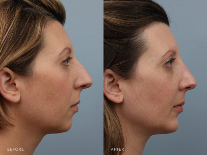 Side by side before and after of a woman who had rhinoplasty surgery done in Albany, NY. Her nasal hump was taken down to give her a straighter bridge and more feminine nose. | Albany, Latham, Saratoga NY, Plastic Surgery