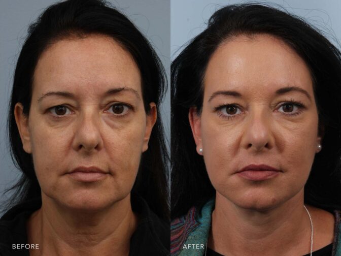 Side by side before and after of brunette middle aged woman who had a facelift done in Albany, NY. Excess skin and fat around the neck and face have been removed and she looks years younger. | Albany, Latham, Saratoga NY, Plastic Surgery