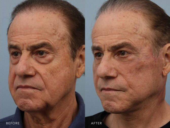 Side by side of an older man before and after facelift surgery in Albany, NY. Excess skin and fat around his neck and face have been removed and he looks years younger. | Albany, Latham, Saratoga NY, Plastic Surgery
