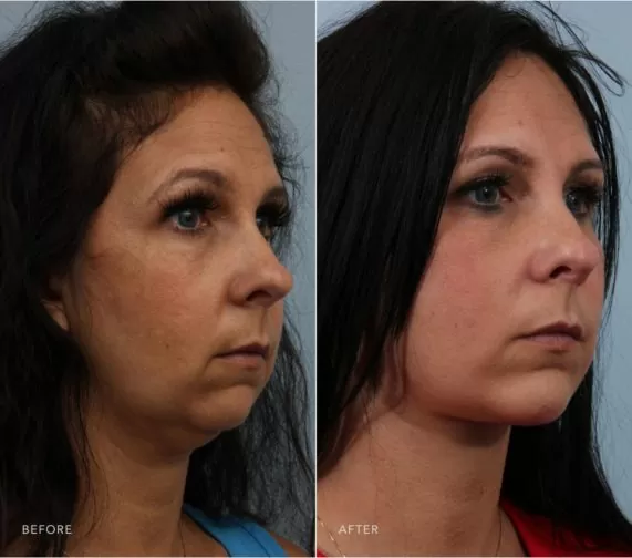 Closeup of a female patient before and after a deep plane facelift, chin augmentation, and facial liposuction