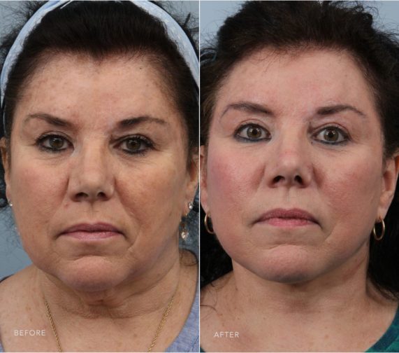 Closeup of a female patient before and after a deep plane facelift which gave the mid and lower face a youthful look