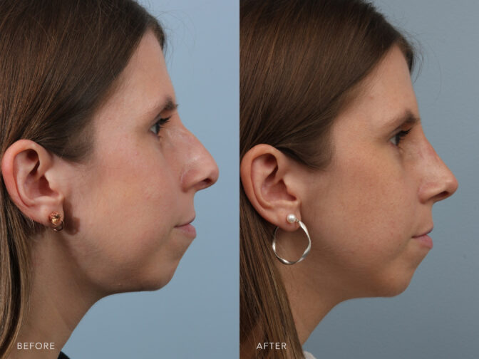 Before and after of a woman who had rhinoplasty surgery in albany, NY. Her nasal hump was shaved down so she now has a straighter bridge and more feminine nose. | Albany, Latham, Saratoga NY, Plastic Surgery