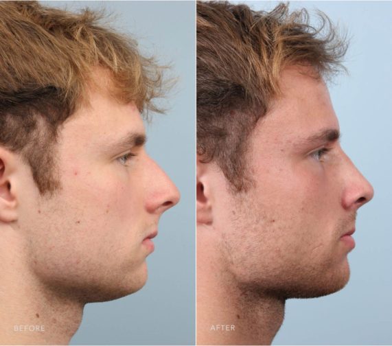 Closeup of a male patient before and after having rhinoplasty plastic surgery in Albany NY to remedy an oversized nose