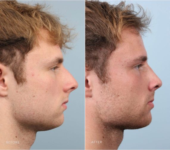 Revision Rhinoplasty Photo Gallery - DrDavid WKim