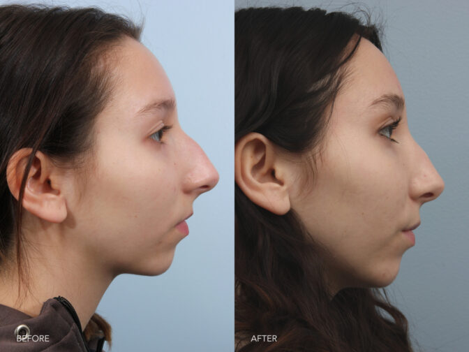 Side by side photo of a young woman who had rhinoplasty surgery in Albany, NY. Her nasal hump was removed for a smaller, straighter, more feminine nose. | Albany, Latham, Saratoga NY, Plastic Surgery