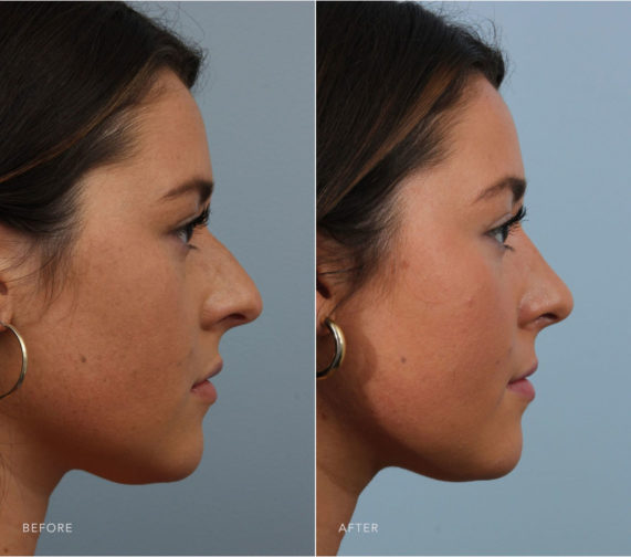 Closeup of a female patient before and after undergoing closed rhinoplasty plastic surgery in Albany, NY.