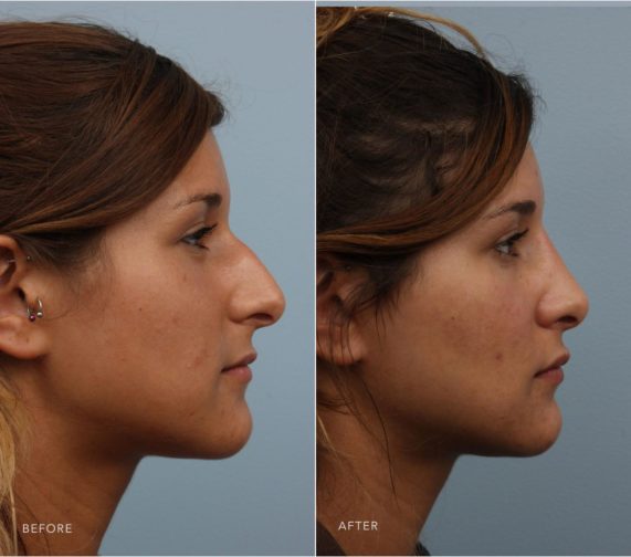 Closeup of a female patient before and after having rhinoplasty plastic surgery to remedy a crooked and drooping nose