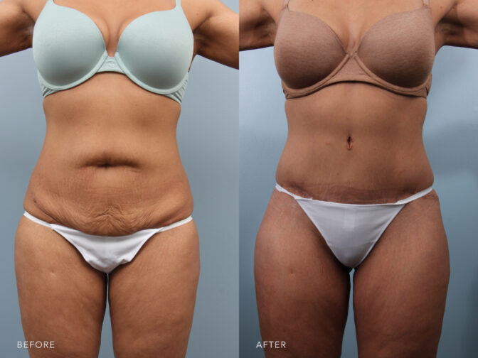 Side by side before and after of a woman's midsection after tummy tuck surgery in Albany, NY. Excess skin and fat of the stomach area has been removed and she is now flat and toned.| Albany, Latham, Saratoga NY, Plastic Surgery