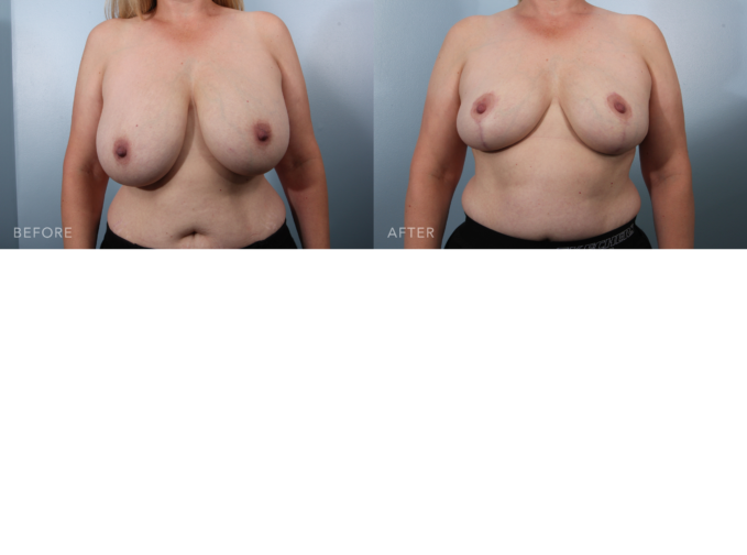 A photo of a woman's body before and after the Breast Reduction procedure. The before picture shows a hunched shoulders or poor posture due to her breast weight pulling forward. The after photo shows a better posture with less strain on the upper body. | Albany, Latham, Saratoga NY, Plastic Surgery