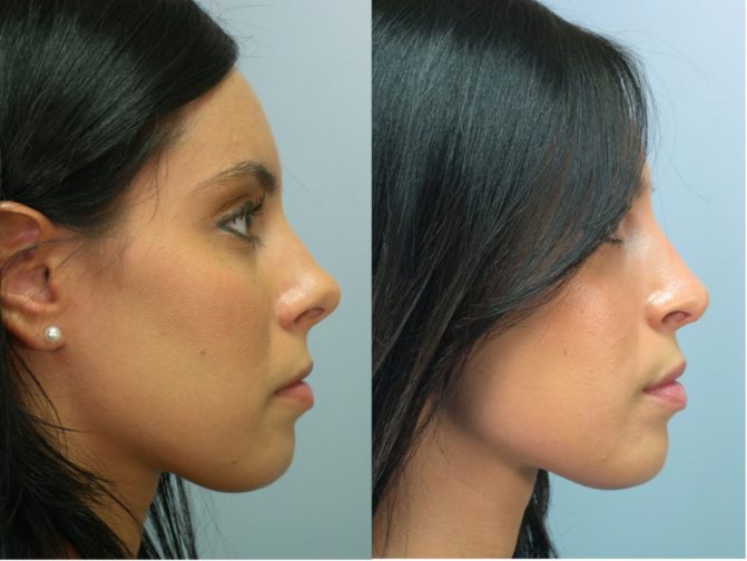 before and after photos showcasing rhinoplasty results