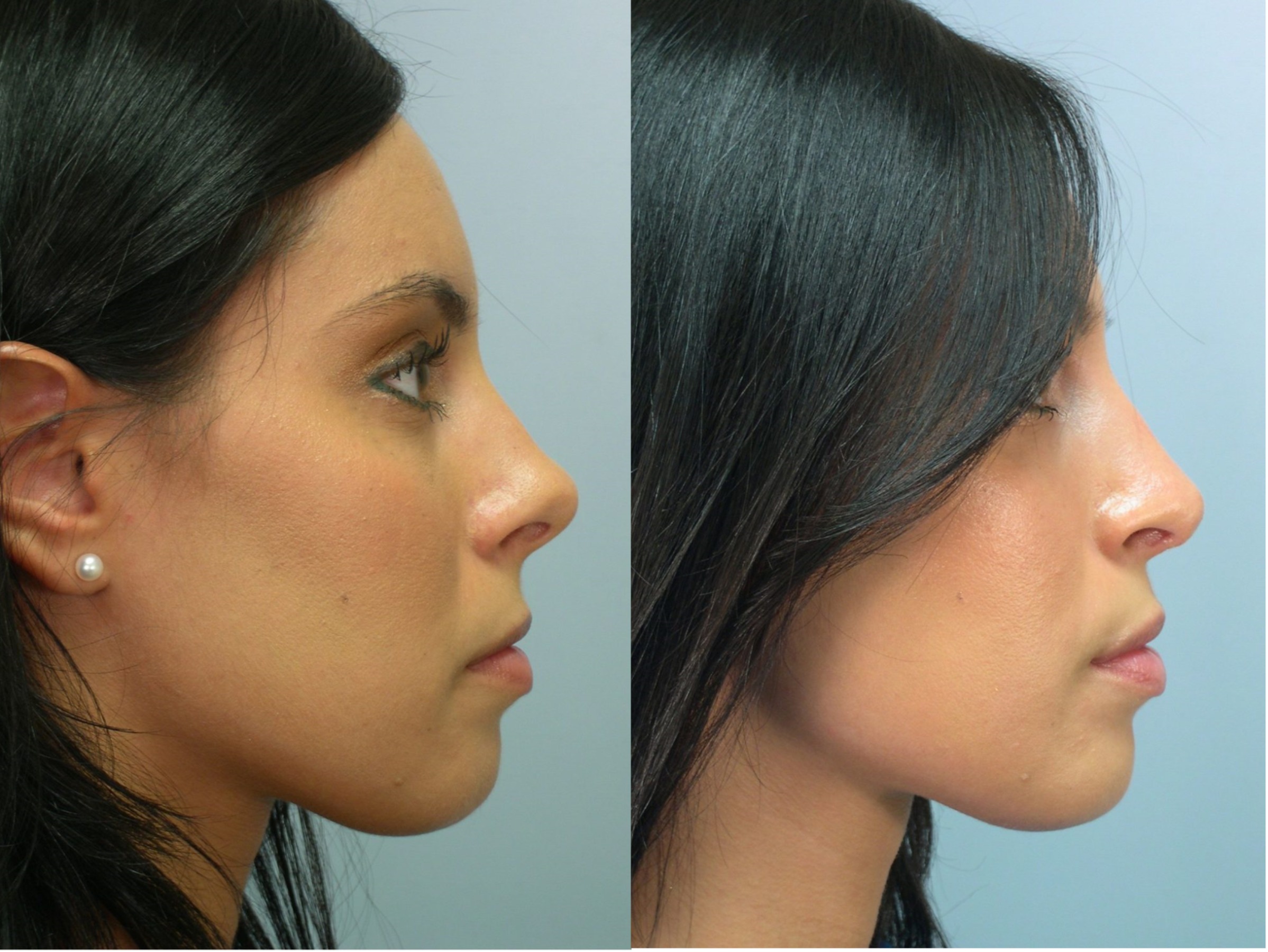 Denver Revision Rhinoplasty Before and Afters - Raval Facial Aesthetics