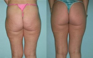 showcasing the results of a patient who has undergone a Brazilian butt lift plastic surgery procedure
