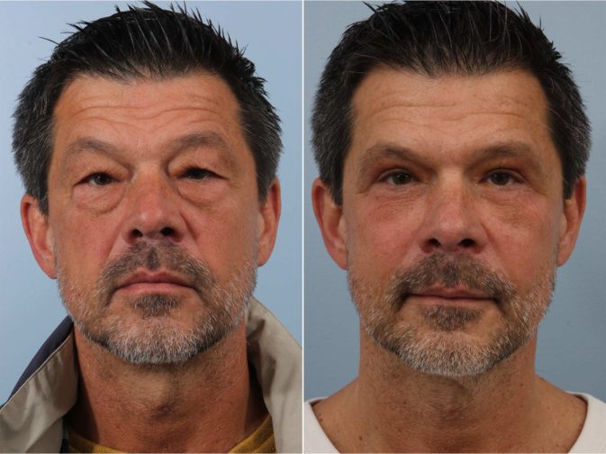 Closeup of a male patient before and after blepharoplasty surgery, which removed undereye bags and puffiness