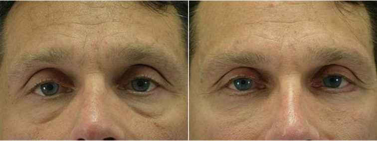 Closeup of a male's eyes before and after blepharoplasty plastic surgery which removed excess skin on his lower eyelids