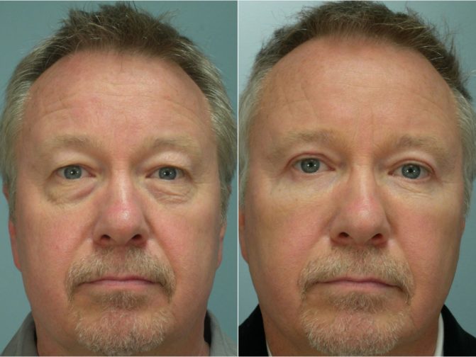 Closeup of a male patient before and after blepharoplasty surgery, resulting in excess skin being removed