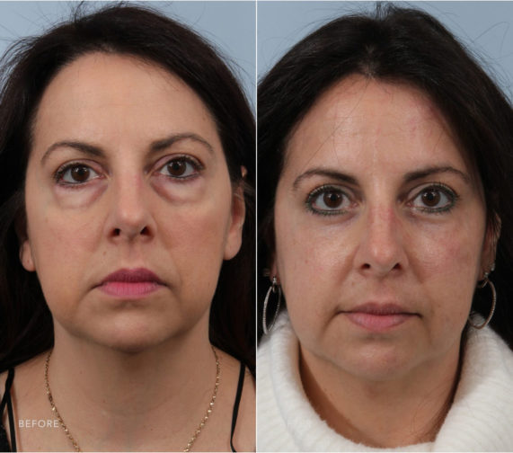 Closeup of a female patient before and after blepharoplasty surgery, which reduced puffy undereyes for a younger look