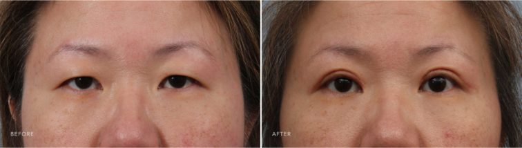 Closeup of a female patient before and after blepharoplasty, which rejuvenates the eyelids for a refreshed look