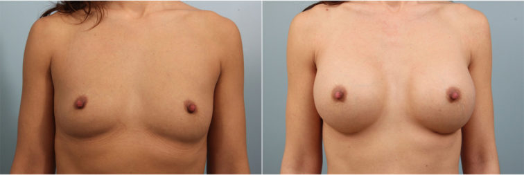 Closeup of a female before and after breast augmentation surgery, with round silicone implants and natural results