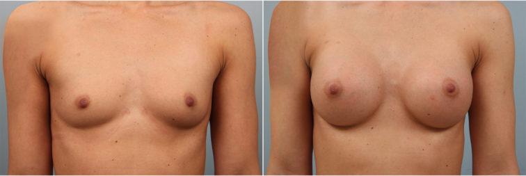 Closeup of a female before and after breast augmentation surgery, which corrected asymmetrical breasts