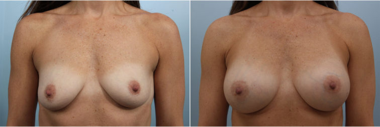 Closeup of a female before and after breast augmentation surgery, showing fuller breasts with silicone implants