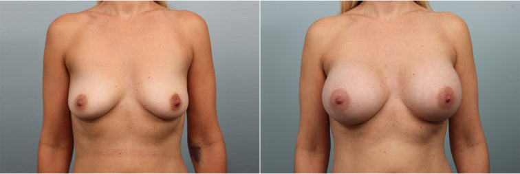 Closeup of a female before and after breast augmentation surgery, with 385 CC silicone implants placed under the muscle