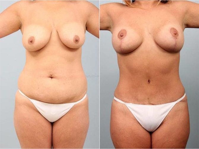 Closeup of female's midsection before and after tummy tuck surgery to remove loose skin and stretch marks