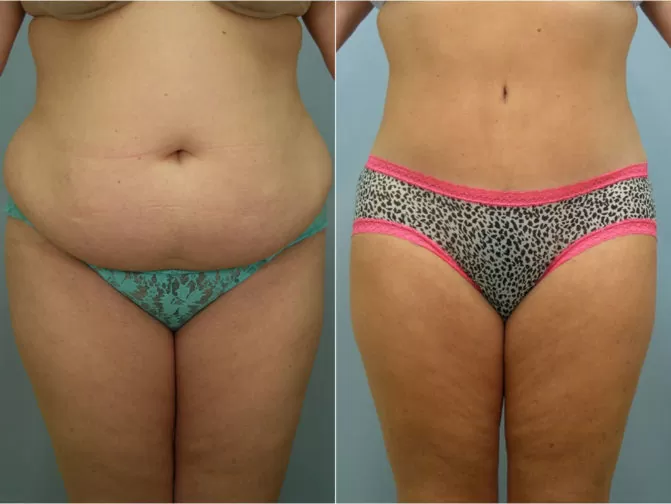Closeup of female's midsection before and after tummy tuck surgery with extensive sculpting of the abdomen and flanks