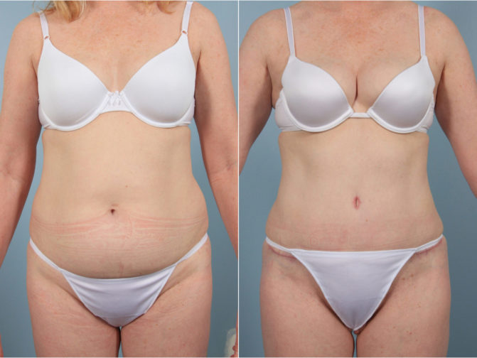 Closeup of female's midsection before and after tummy tuck surgery and liposuction 360 for sculpted abdomen