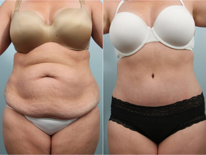 Closeup of female's midsection before and after tummy tuck surgery to remove excess skin and fat