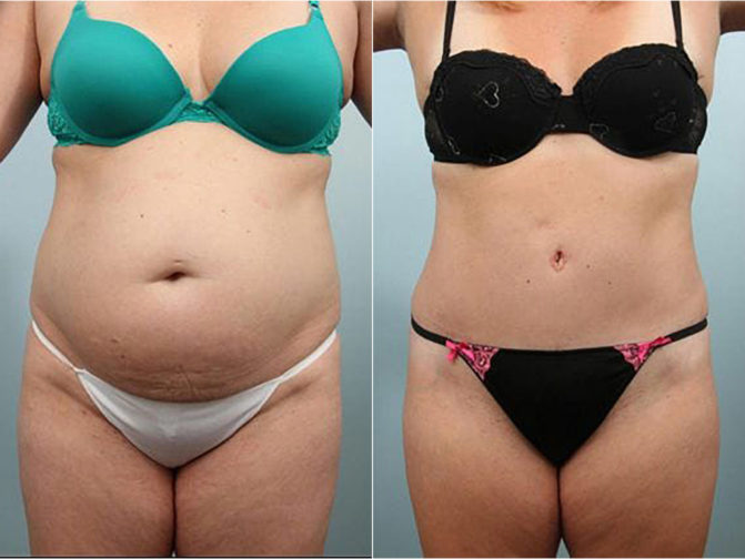 Closeup of female's midsection before and after tummy tuck surgery with double layer reconstruction of abdominal muscles