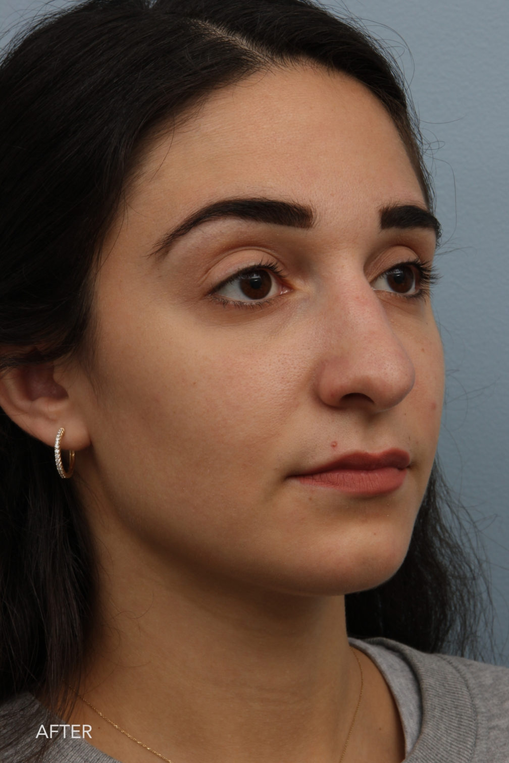 Rhinoplasty & Nasal Reconstruction Gallery | The Williams Center ...