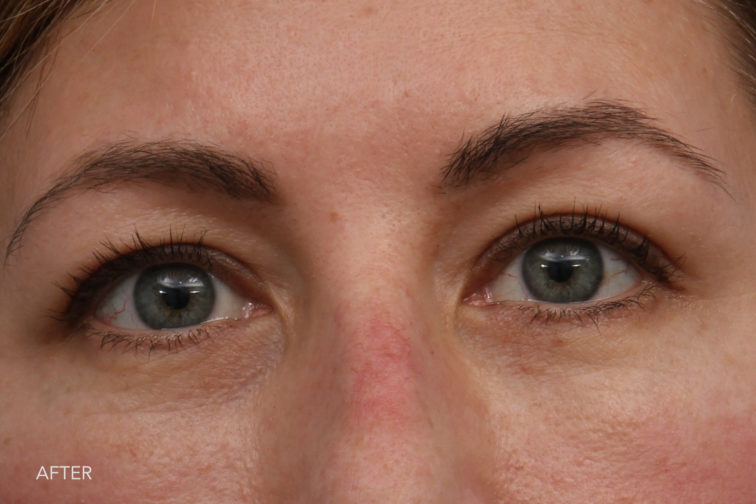 close up frontal view of a woman with green eyes after blepharoplasty or eyelid surgery with refreshed eyes and no excess skin